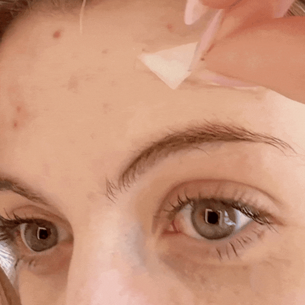 Fade Cystic Acne & Scars In Your Sleep