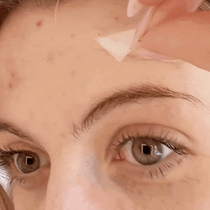 Fade Cystic Acne & Scars In Your Sleep