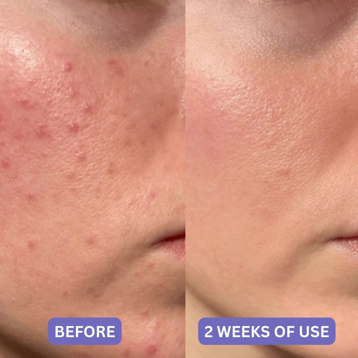 Fade Cystic Acne & Scars In Your Sleep